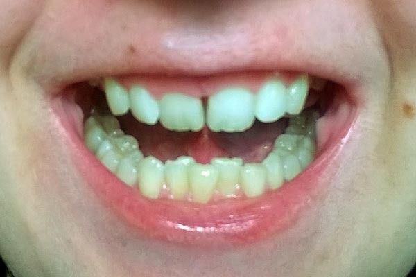 My-teeth1_zps6b8o4cqj.jpg