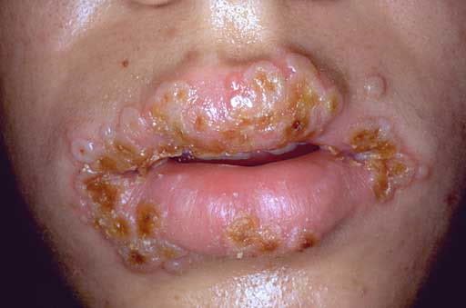 oral herpes