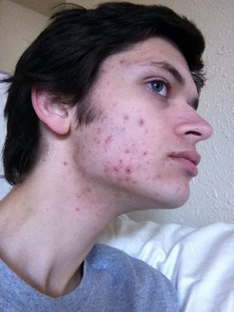 paleo before and after acne