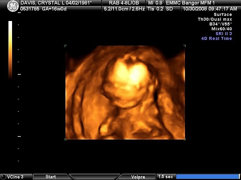 3d ultrasound 20 weeks boy. 20 Weeks Along It#39;s A Boy!