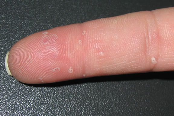 Teeny, tiny fluid-filled bumps on my fingers?? | Yahoo Answers